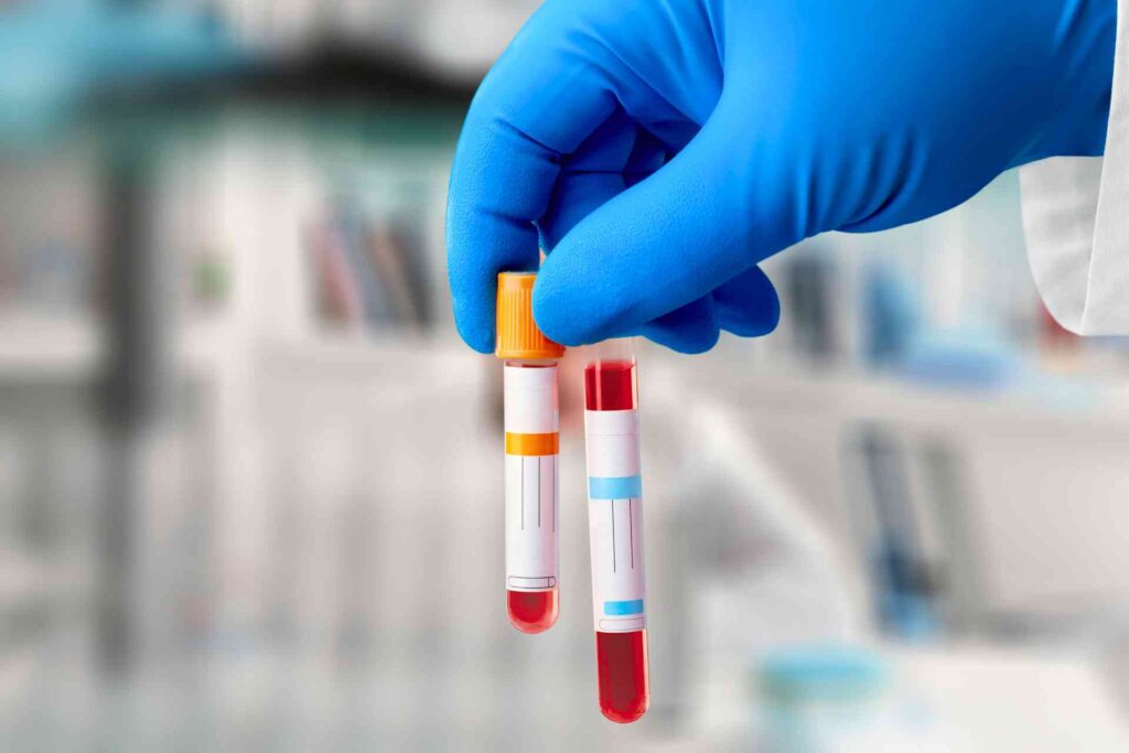 Fiale di sangue per indicare esame del colesterolo