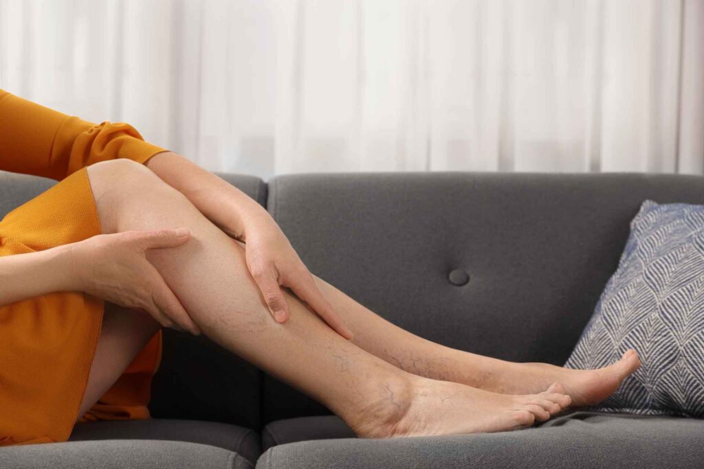 Donna seduta sul divano che si massaggia le gambe con piccole vene varicose