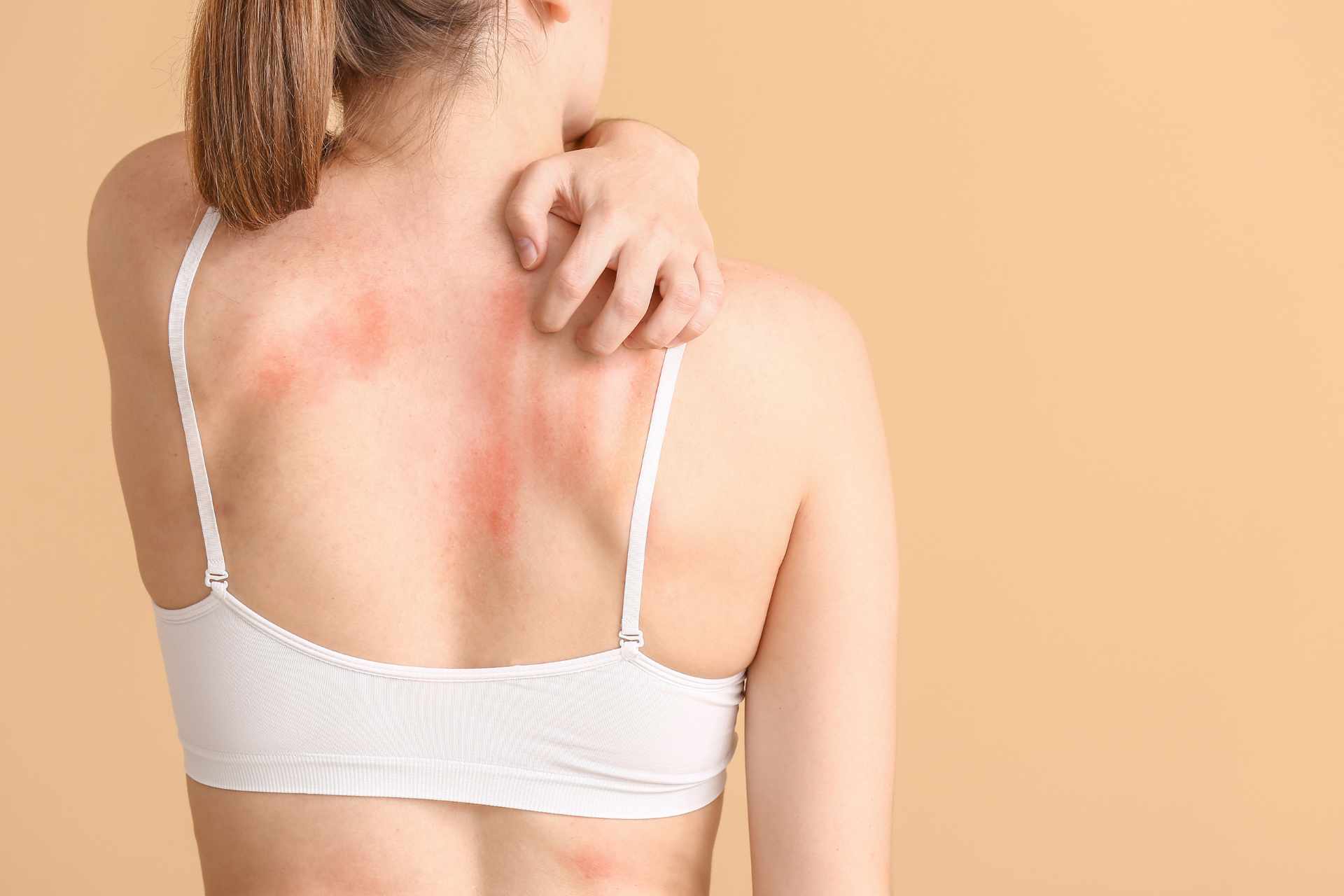 Un comune batterio della pelle all’origine della dermatite atopica?