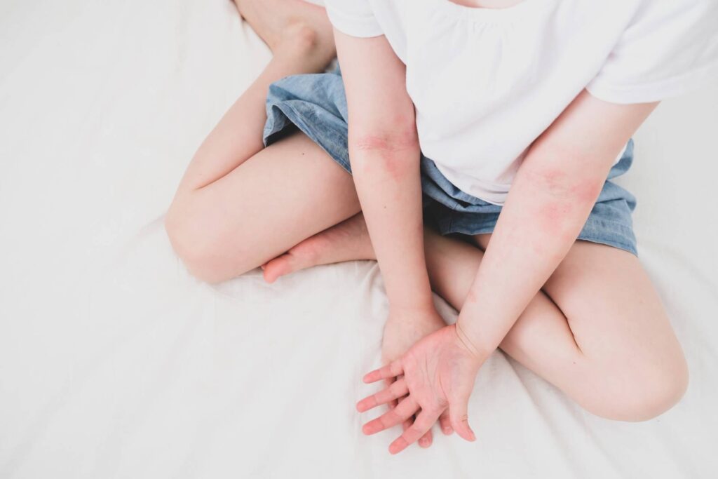 bambino con dermatite atopica sulle braccia